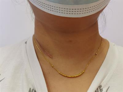 Comparison of Supraclavicular Oblique Incision With Traditional Low Collar Incision Approach for Thyroidectomy in Differentiated Thyroid Cancer